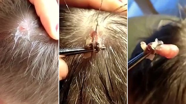 Shocking Viral Video Shows Botfly Larva Removed from Woman’s Scalp After Cancun Trip